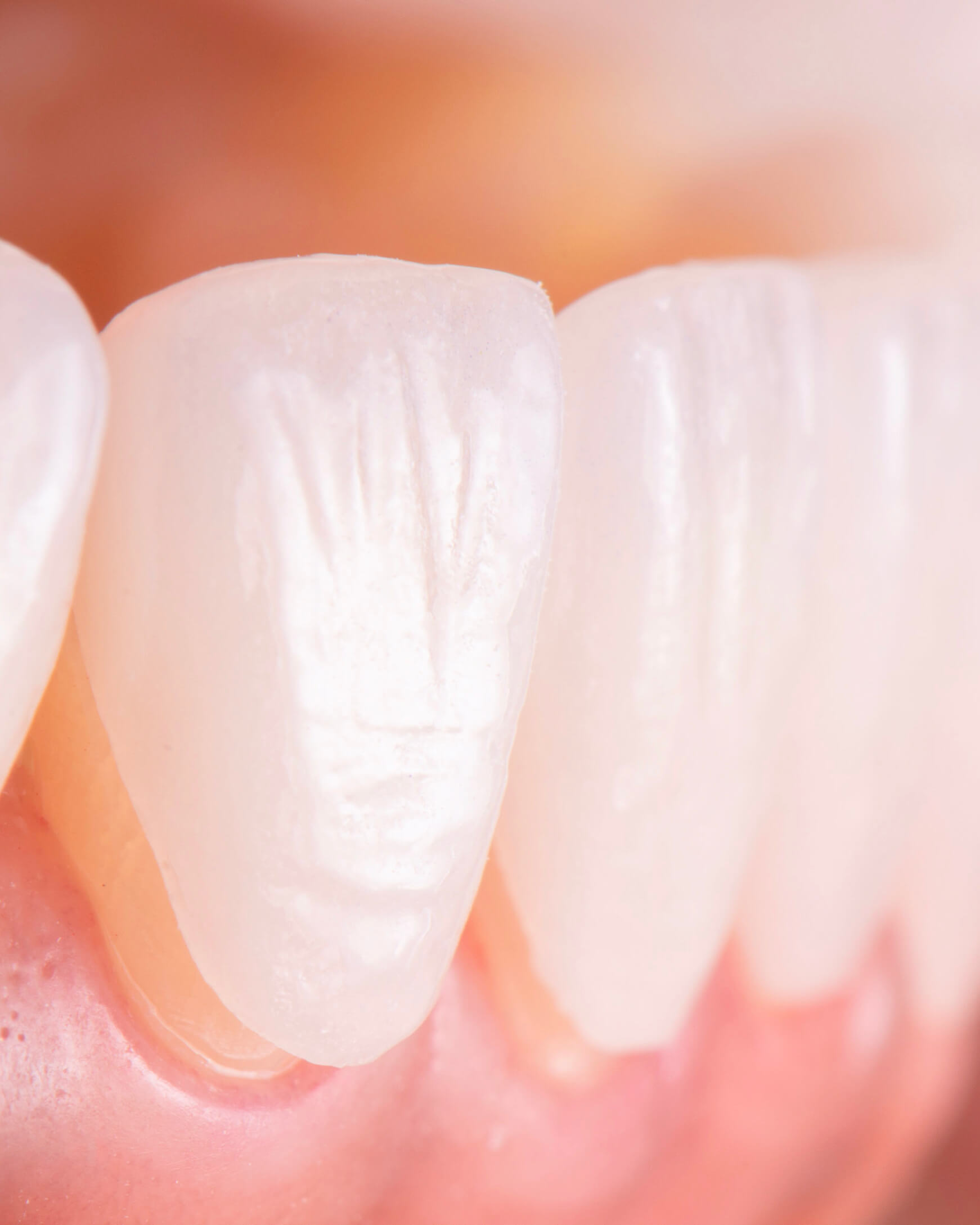 dental veneer antalya